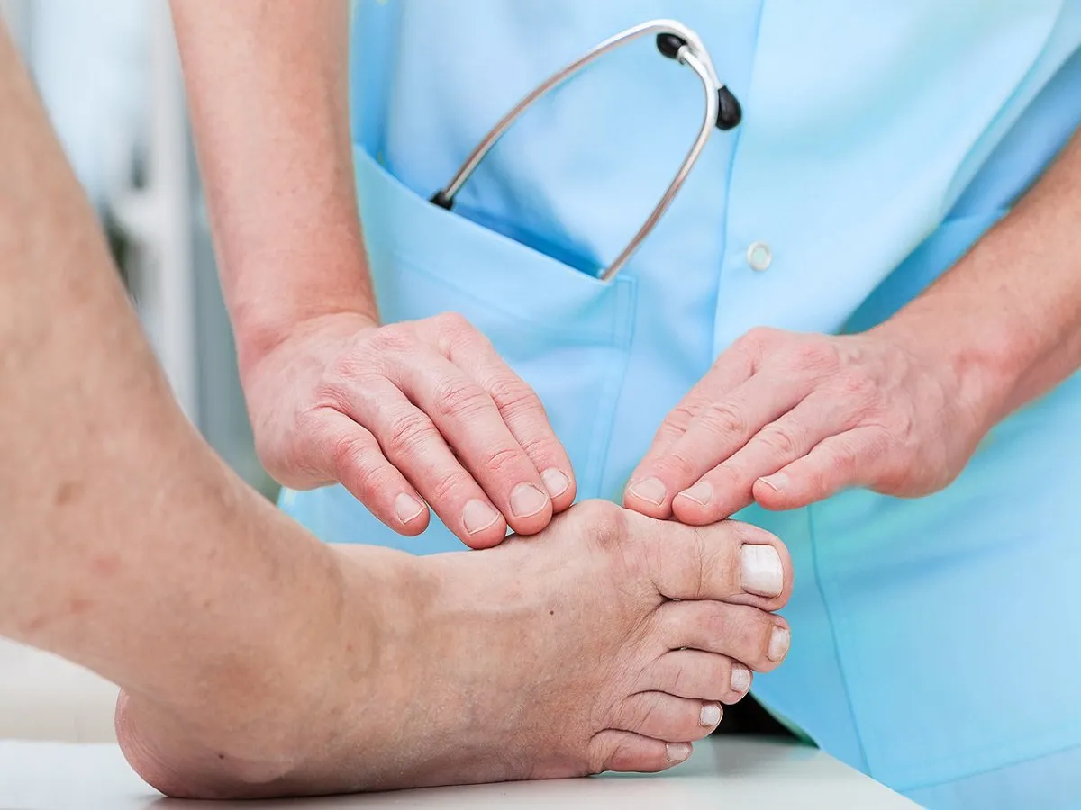 Gout vs Bunion: A Comparative Analysis of Foot Conditions